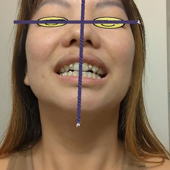 Nalchajian Orthodontics - How it looks like with a straight horizontal line and an adjusted slanted vertical line. - Orthodontists Near Me - Clovis, California Nalchajian Orthodontics - How it looks like with a straight horizontal line and an adjusted slanted vertical line. - Orthodontists Near Me - Clovis, California