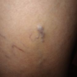 OSF Saint Anthony Medical Center - Varicose  vein / CVI