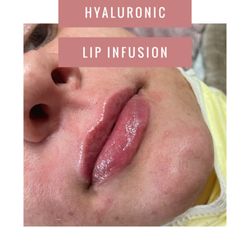 Studio 92 Salon & Spa - HYALURONIC LIP INFUSION