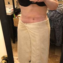3 months post surgery