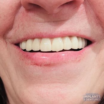 Mesa Dental Implants and Dentures - Cosmetic Dentists Near Me - Mesa, Arizona Mesa Dental Implants and Dentures - Cosmetic Dentists Near Me - Mesa, Arizona