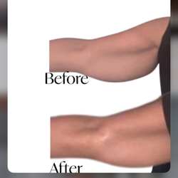 Before And After arm slimming