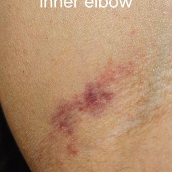 Artistry Salon & Spa - Inner elbow bruise from wax Sally did - Hair Salons Near Me - Sacramento, California Artistry Salon & Spa - Inner elbow bruise from wax Sally did - Hair Salons Near Me - Sacramento, California