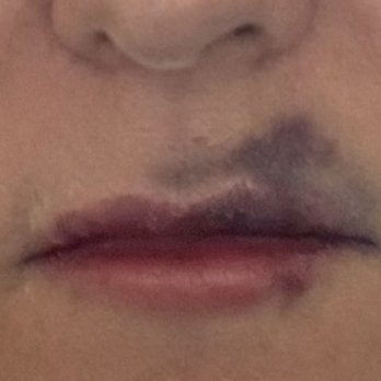 Serenity Dermatology - Day 3 after LaserAway Woodlands lip filler procedure. - Medical Spas Near Me - Galveston, Texas Serenity Dermatology - Day 3 after LaserAway Woodlands lip filler procedure. - Medical Spas Near Me - Galveston, Texas