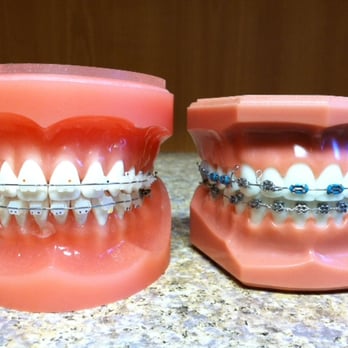 Hooray 4 Teeth - Clear ceramic brackets vs. Traditional brackets - General Dentistry Near Me - Hayward, California