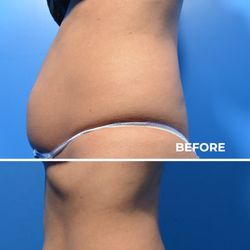 Skin Perfect Medical Aesthetics - Wow! Before and after CoolSculpting.