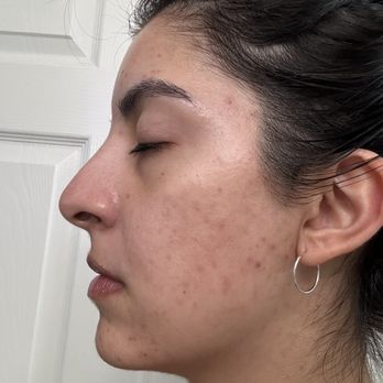 Skin By Nayra G - Before - Skin Care Near Me - Downey, California Skin By Nayra G - Before - Skin Care Near Me - Downey, California