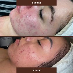 Freya Medispa & Wellness - Clear skin is possible! This client's results came from a plan using microdermabrasion, deep extractions, chemical peels, and photofacials.