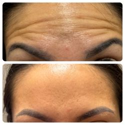 Ageless Beauty Aesthetics - Frontalis Before/After