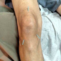 Desert Ridge Acupuncture - Accupuncture