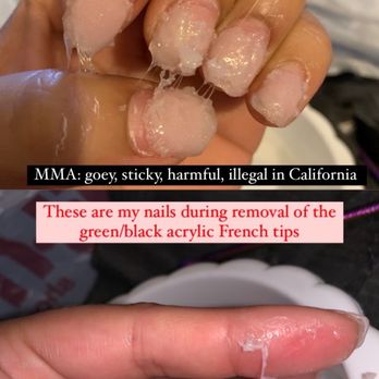 Happy Day Nails & Spa - After 3 weeks I did I soak off removal and discovered they use MMA monomer - Nail Salons Near Me - Sacramento, California Happy Day Nails & Spa - After 3 weeks I did I soak off removal and discovered they use MMA monomer - Nail Salons Near Me - Sacramento, California