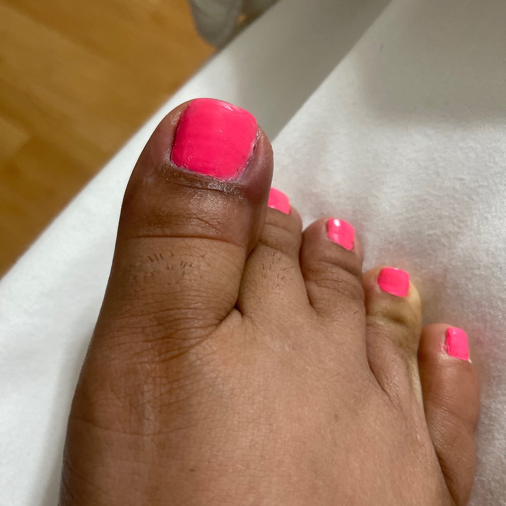 Million Nails & Bar - Infected toe. - Nail Salons Near Me - Grand Prairie, Texas