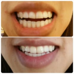 Joe H Lawrence, DDS - Before and 45 minutes after! Thanks Dr. Joe!