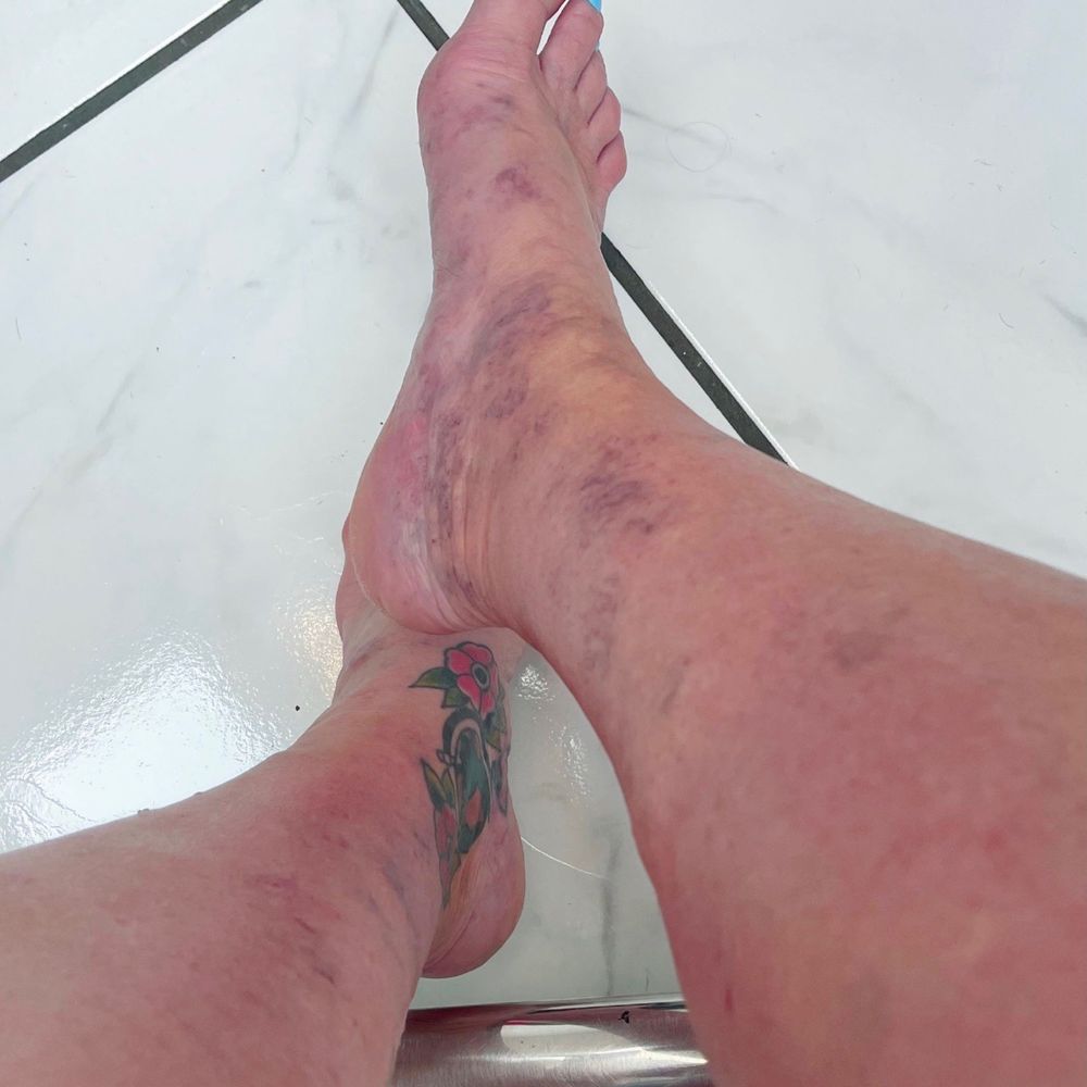 Anila's Salon - Ugly ass vericose veins BEFORE. - Hair Salons Near Me - San Antonio, Texas Anila's Salon - Ugly ass vericose veins BEFORE. - Hair Salons Near Me - San Antonio, Texas