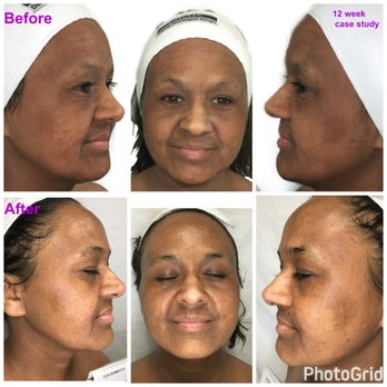 SHOW A LITTLE SKINcare - 12 treatments 1 x week for 12 weeks - Skin Care Near Me - Modesto, California SHOW A LITTLE SKINcare - 12 treatments 1 x week for 12 weeks - Skin Care Near Me - Modesto, California