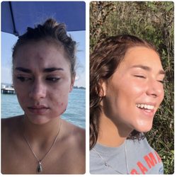 Grekin Skin Institute - Dr. Grekin changed my 19 year old's life! Her skin is beautiful in just 3 months!