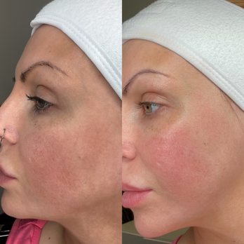 Lumiere Beauty - Acne Treatment Near Me - Surrey, British Columbia Lumiere Beauty - Acne Treatment Near Me - Surrey, British Columbia