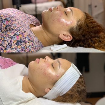 Mixed Esthetics - Acne Treatment (2 week progress) - Waxing Near Me - San Diego, California