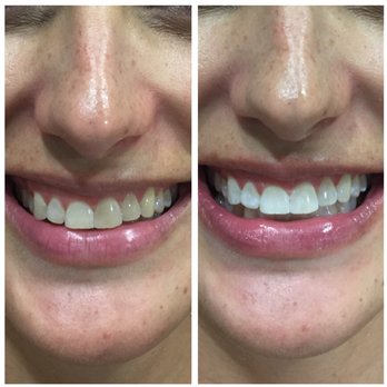 Joana Ganeshappa DDS - We offer In-Office and Take-Home teeth whitening options to suit your lifestyle. - Cosmetic Dentists Near Me - San Antonio, Texas