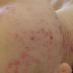 Before Treatment