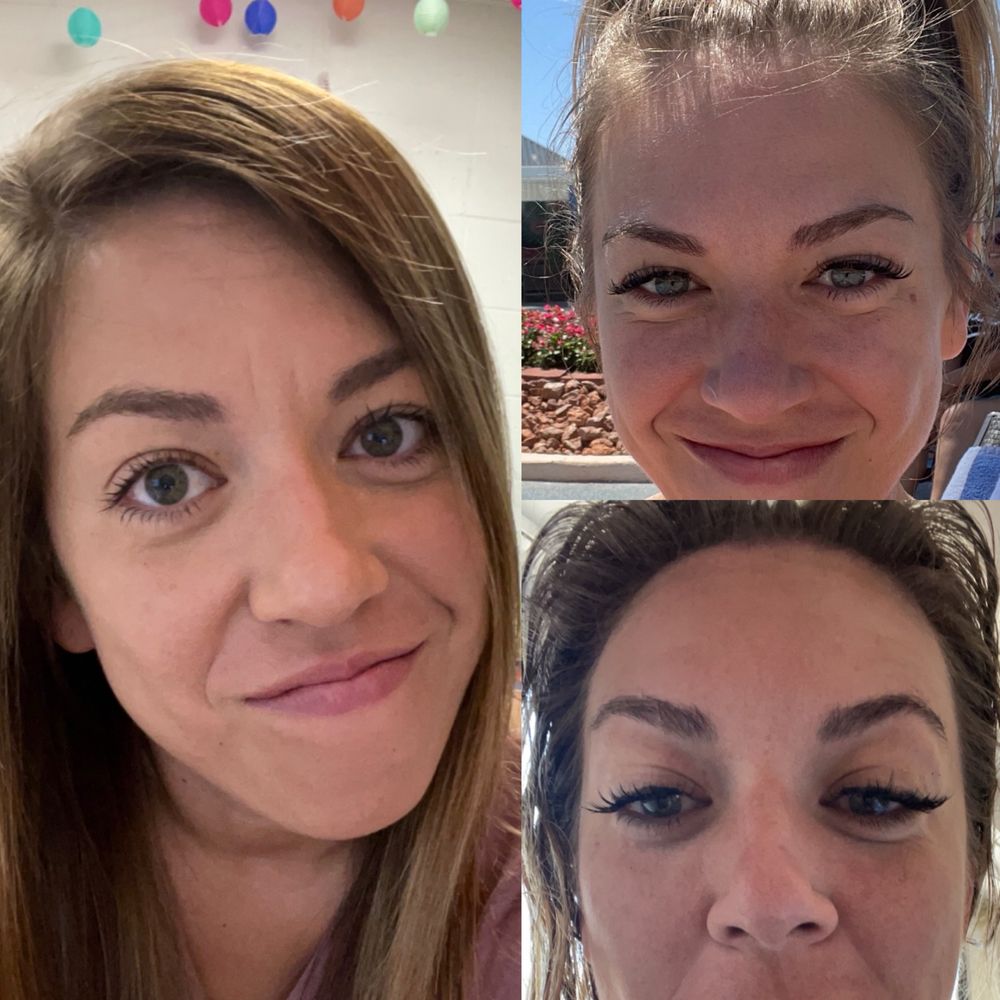 Midwest Aesthetics - Left side is pre-Botox; Right side two are 2 weeks afterwards. (Notice my 11 lines are gone as is the center one across my forehead). - Medical Spas Near Me - Johnston, Iowa Midwest Aesthetics - Left side is pre-Botox; Right side two are 2 weeks afterwards. (Notice my 11 lines are gone as is the center one across my forehead). - Medical Spas Near Me - Johnston, Iowa