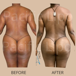 Pacific Lipo - Newport Beach