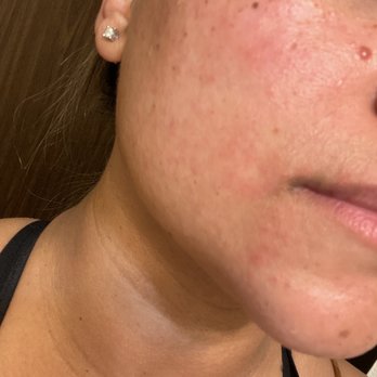 Skin Renewal Center - My skin is literally still on fire, so be careful! - Laser Hair Removal Near Me - Davis, California Skin Renewal Center - My skin is literally still on fire, so be careful! - Laser Hair Removal Near Me - Davis, California