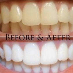 Pink Beauty Medical Center - Teeth whitening