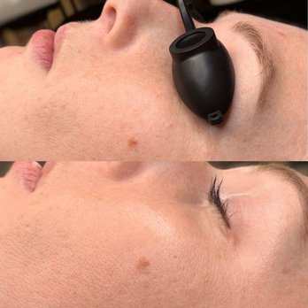 SLO Skin Studio - Acne Treatment Near Me - San Luis Obispo, California