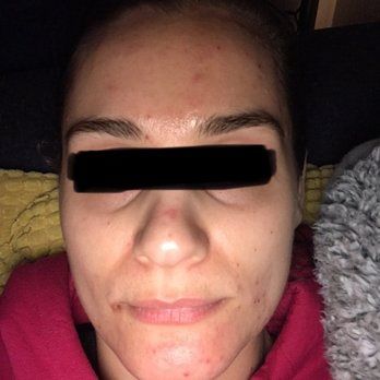 Ingrid Thompson SkinCare - BEFORE: this was one of my first facials with Ingrid. - Cosmetics & Beauty Supply Near Me - Beverly Hills, California Ingrid Thompson SkinCare - BEFORE: this was one of my first facials with Ingrid. - Cosmetics & Beauty Supply Near Me - Beverly Hills, California