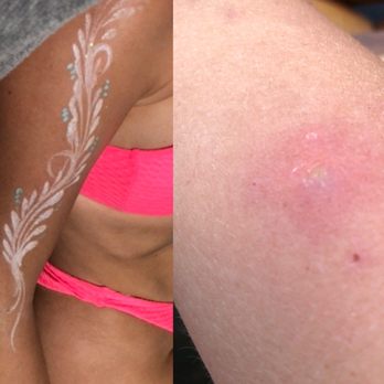 Taboo Tulum - The nasty and very painful skin infection caused by Taboo's unhygienic bodypaint that they refused to take any and all responsibility for. - Mediterranean Near Me - Tulum, ROO