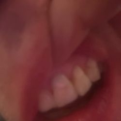 Dugas Dental - Lewis Center - Obvious color wrong. Dental in Lewis Center chopped off my front tooth and horribly replaced it.