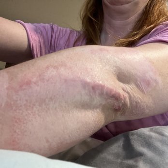 Shaheen Khosla, MD - Here is is now, after 3 CO2 laser treatments. It no longer hurts and burns. - Dermatologists Near Me - Redwood City , California