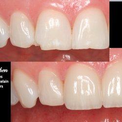 Synergy Dental Group - Porcelain Veneers can look natural.         Before and After