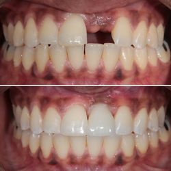 Chicago Dental Solutions - Lincoln Dental Care - Single Missing Tooth Replaced with Dental Implant