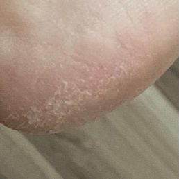 Untouched heel Untouched heel