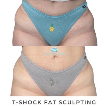 Cloud9Cryo - T-Shock Fat Sculpting helped my client slim down her pelvis and side hips to get that perfect curve. - Cryotherapy Near Me - Long Beach, California