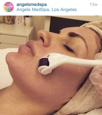 Microneedling - A therapy in which a device delivers tiny needle pricks to stimulate the skin’s natural healing processes which can minimize fine lines and wrinkles and improve the appearance of scars in all skin types and with minimal recovery. Can also improve the appearance of hyperpigmentation and melasma. Has also been effective in the treatment of acne and acne scars. This treatment is used with a selection of products from “It’s a Tripp” medical-grade skin care line, pharmaceutical grade, and Glo skin beauty products. Microneedling - A therapy in which a device delivers tiny needle pricks to stimulate the skin’s natural healing processes which can minimize fine lines and wrinkles and improve the appearance of scars in all skin types and with minimal recovery. Can also improve the appearance of hyperpigmentation and melasma. Has also been effective in the treatment of acne and acne scars. This treatment is used with a selection of products from “It’s a Tripp” medical-grade skin care line, pharmaceutical grade, and Glo skin beauty products.