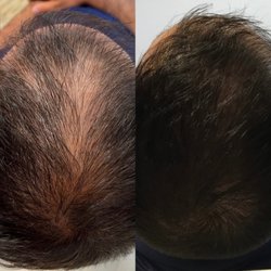 PRP Hair Restoration