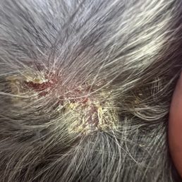 The Burned skin area looks like this from lower head to neck. No where else on body. I saw when perfume was sprayed.