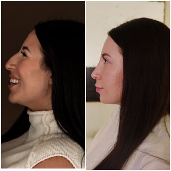 Vladimir Grigoryants, MD - 1 year post op - Cosmetic Surgeons Near Me - Glendale, California Vladimir Grigoryants, MD - 1 year post op - Cosmetic Surgeons Near Me - Glendale, California