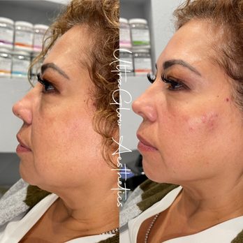 UltraGlow Aesthetics - Face filler (Cheek and Jawline) - Medical Spas Near Me - Las Vegas , Nevada UltraGlow Aesthetics - Face filler (Cheek and Jawline) - Medical Spas Near Me - Las Vegas , Nevada