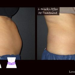 Elite Salon And Medspa - CoolSculpting