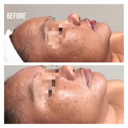 Beautiful Aesthetics By Auyanna - Microderm Brightening Facial