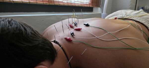 Acupuncture - Schedule your appointment today! Acupuncture - Schedule your appointment today!