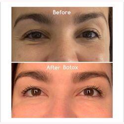 Astar Medical Group - Botox application!! Call today for a consultation !!
