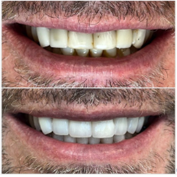 Smile before and after Smile before and after