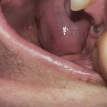 NHOMS - Dover - Other side of my mouth infection broken teeth nerves behind - Oral Surgeons Near Me - Dover, New Hampshire
