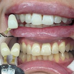 Teeth whitening results Teeth whitening results