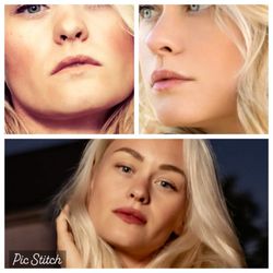 RAE Aesthetics - Before images on top. Newly hydrated and full lips on via bottom image (one syringe).
